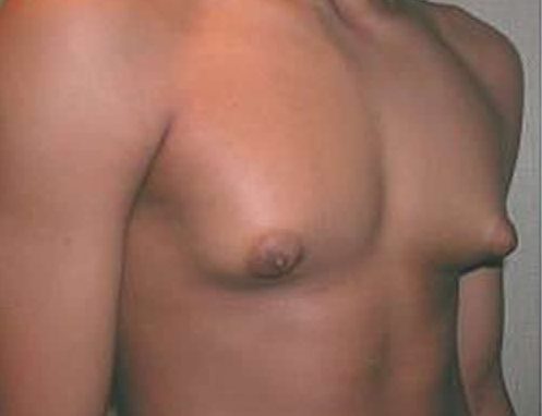 Лечение народными средства грудной железы у мужчин