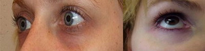 Причины темных кругов под глазами у ребенка способы лечения и профилактики