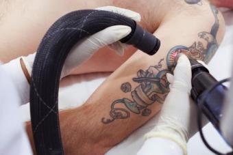 Jak odstranit tetování, pokud vás to nebaví?